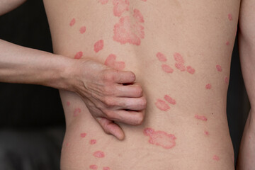 Psoriasis Conditions