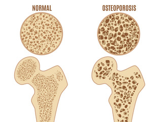Osteoporosis conditions